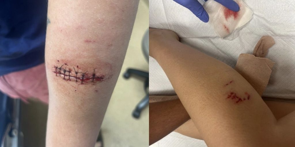 Mother and Daughter Attacked by Dogs During Morning Walk; One Dog Shot by Police